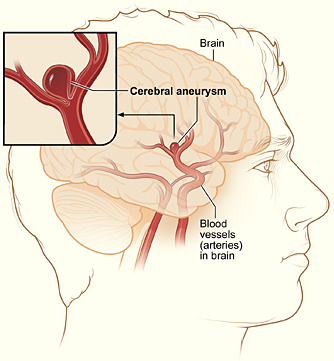 _images/Cerebral_aneurysm_NIH.jpg